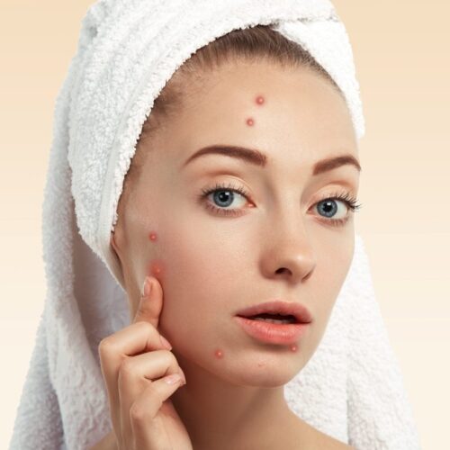 Salon kosmetyczny zabiegi na trądzik Trądzik Wrocław