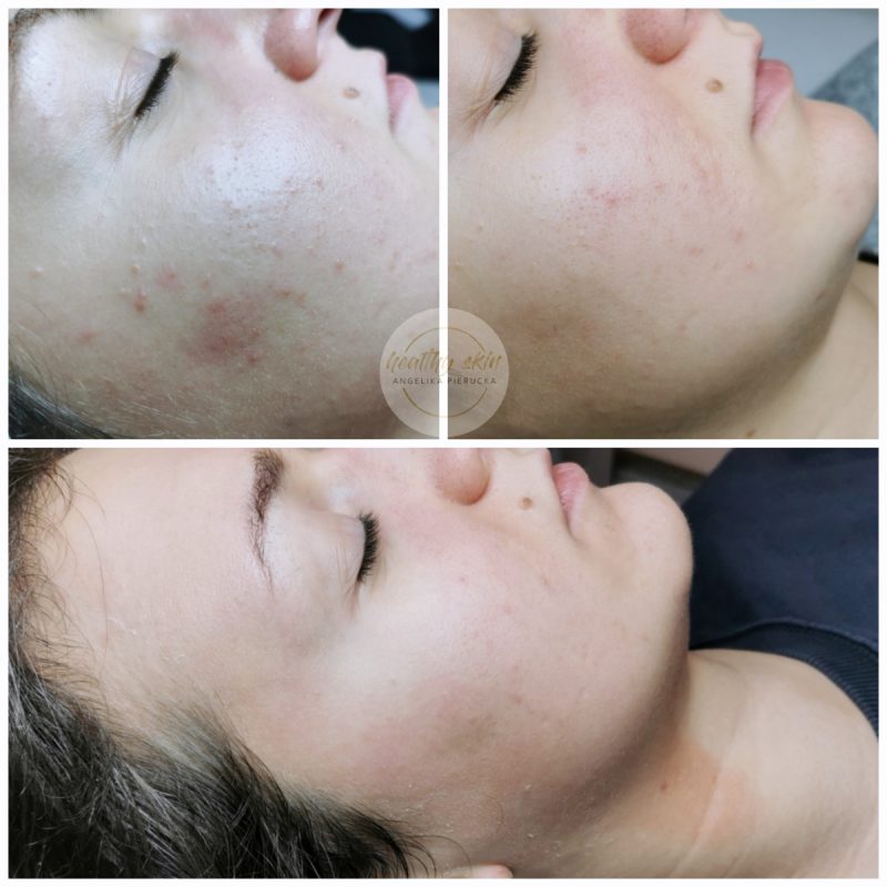 trądziku pospolitego we Wrocławiu kosmetolog