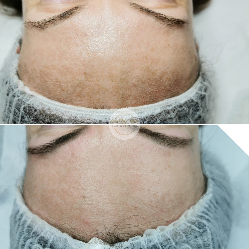 Skuteczny zabieg na plamy na czole, usuwanie przebarwień Wrocław, najlepszy kosmetolog od przebarwień