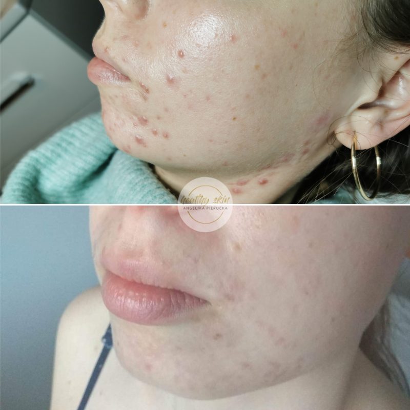 leczenie trądziku Wrocław, najlepszy kosmetolog od trądziku wrocław, zabieg na trądzik