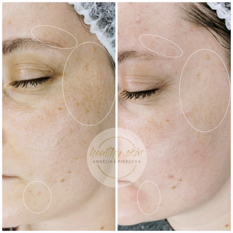 Piegi, plamy na czole, usuwanie nawracających przebarwień