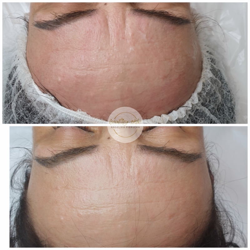 zdrowe naturalne starzenie skóry, zabieg na zmarszczki na czole, jak zapobiegać starzeniu skóry