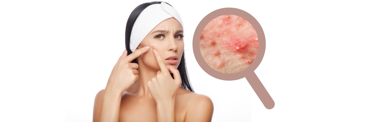 Co to trądzik młodzieńczy i ile trwa?