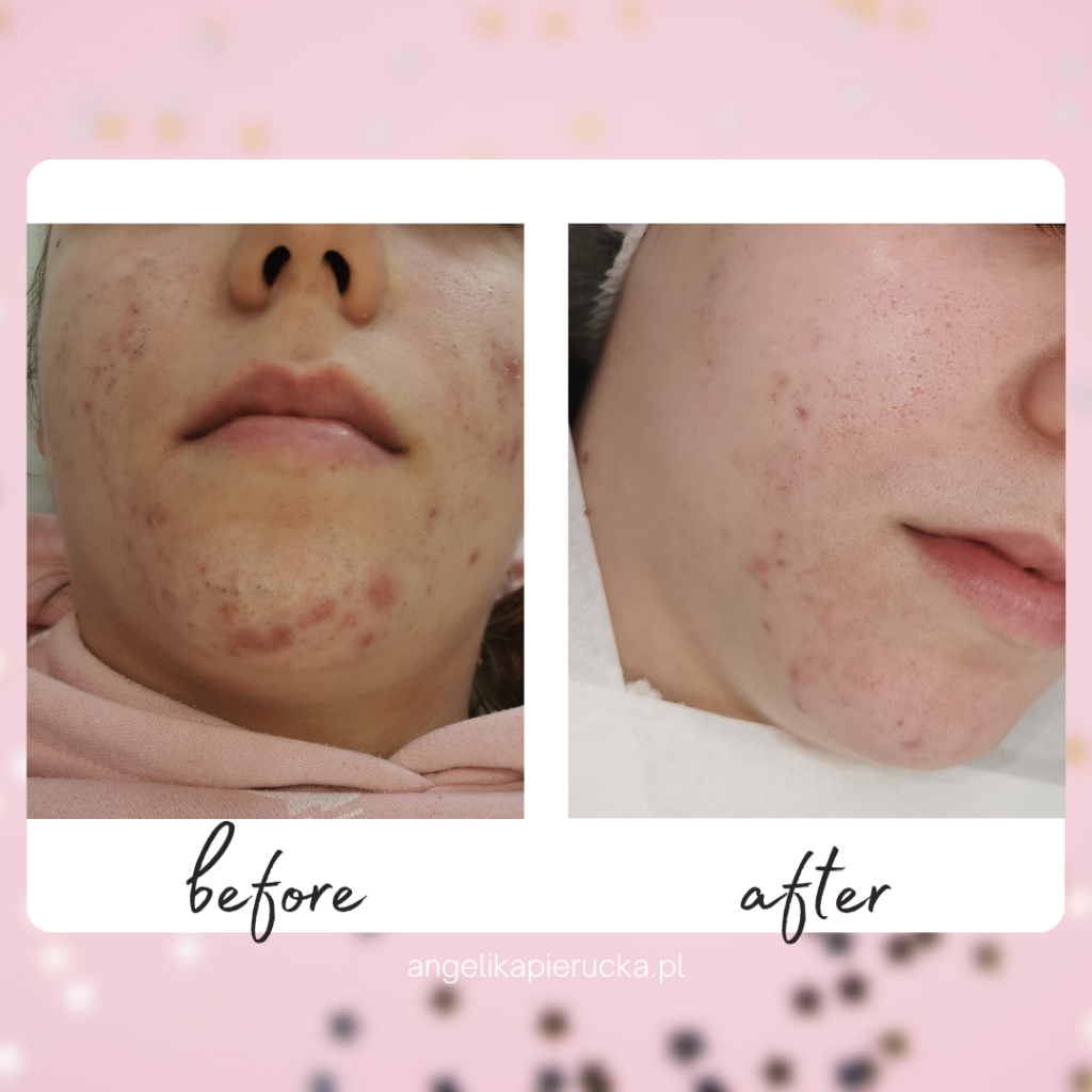 Efekty holistyczne leczenie trądziku, konsultacja kosmetologiczna Healthy Skin Wrocław trądzik