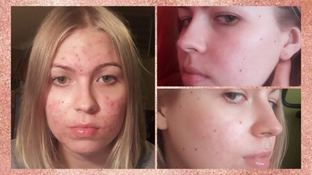 leczenie trądziku izotretynoiną, przed i po, antybiotyki na trądzik, 