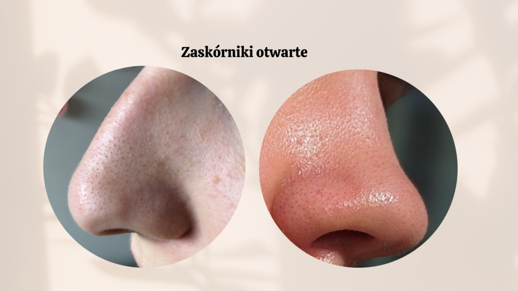 Wągry na nosie - zaskórniki otwarte