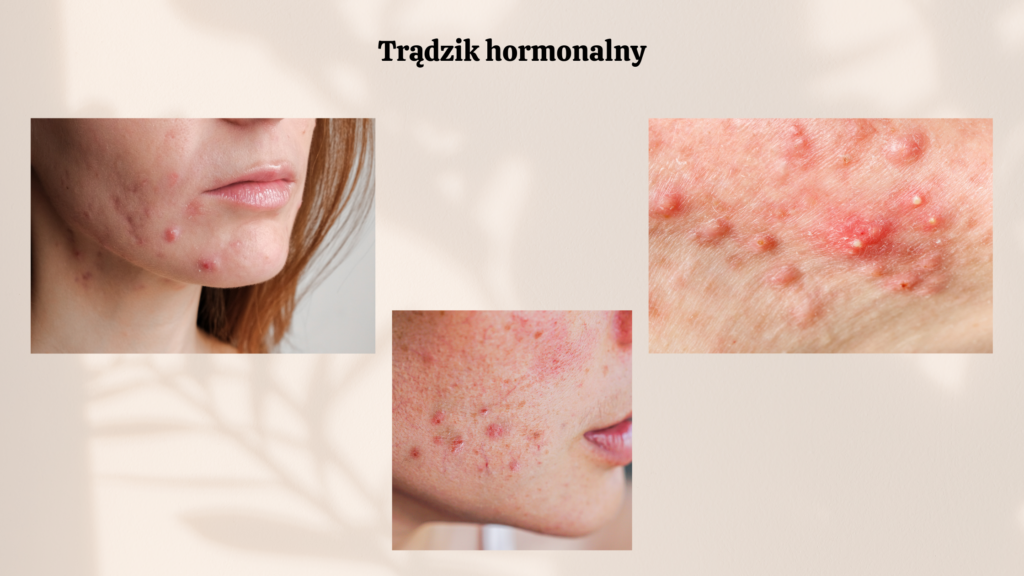  androgeny w trądziku, trądzik hormonalny, jak rozpoznać trądzik hormonalny, jak pozbyć się trądziku hormonalnego, dieta w trądziku hormonalnym, dieta w trądziku, dieta antytrądzikowa, jak uspokoić hormony w trądziku