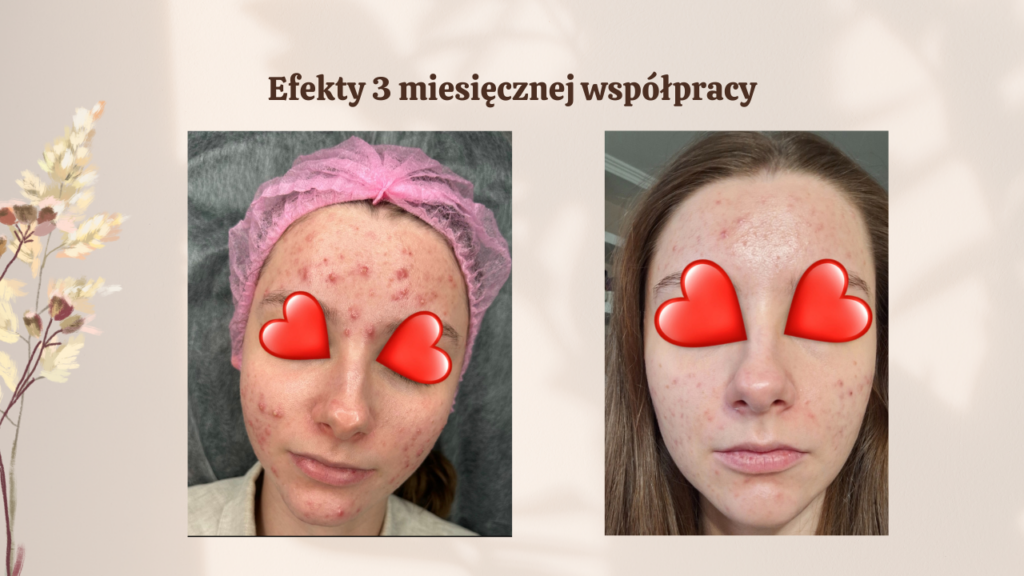 nawrót trądziku, dlaczego trądzik wraca, co na nawrot trądziku