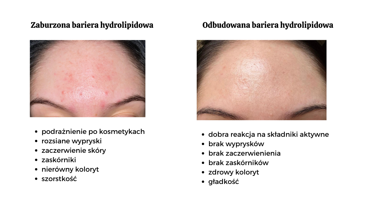 krostki na twarzy, ściągnięta skóra, regeneracja skóry po podrażnieniach, zaskórniki, szorstka skóra, jak odbudować barierę hydrolipidową skóry, warstwa hydrolipidiwa, skóra sucha, wrażliwa, efekty odbudowy bariery hydrolipidowej skóry, przed i po, kosmetolog