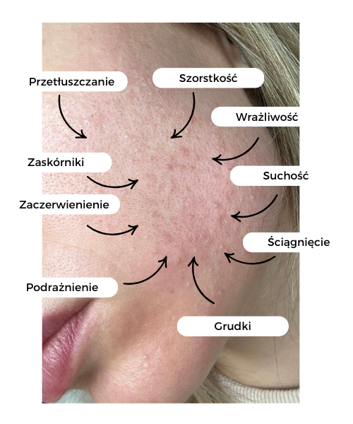 jak odbudować barierę hydrolipidową, uszkodzona bariera hydrolipidowa pielęgnacja domowa, plan pielęgnacji dla zaburzonej bariery hydrolipidowej,