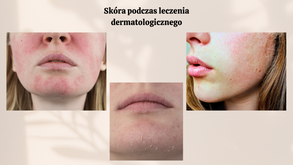 Pielęgnacja skóry w trakcie leczenia trądziku_ Co musisz wiedzieć 