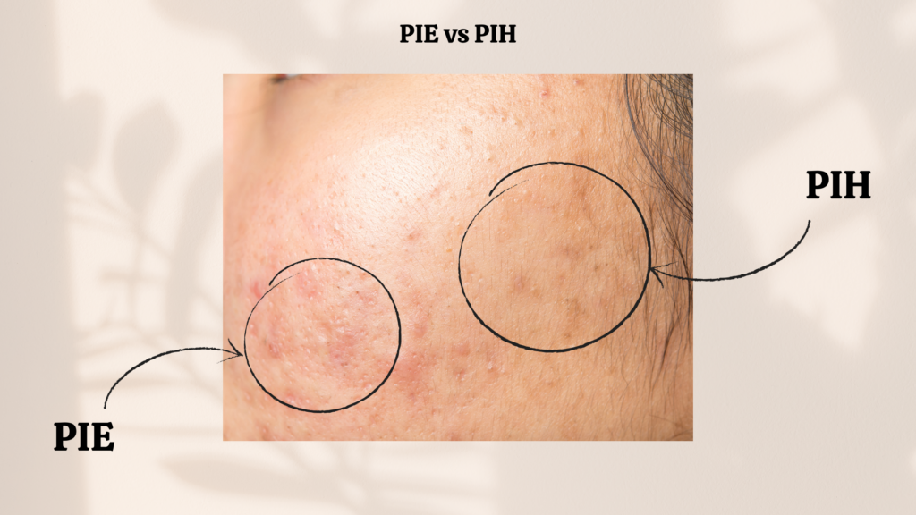 trądzik, przebarwienia potrądzikowe, PIE i PIH, czerwone przebarwienia na twarzy, pielęgnacja skóry, jak pozbyć się przebarwień, kosmetyki na przebarwienia, ochrona przed UV, pielęgnacja cery trądzikowej
