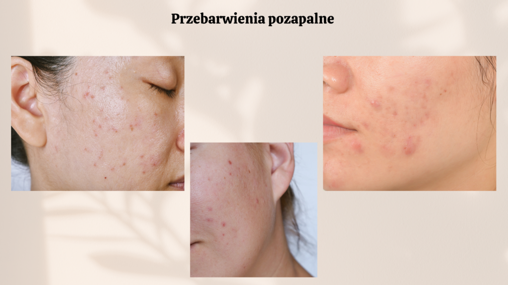trądzik, przebarwienia potrądzikowe, PIE i PIH, czerwone przebarwienia na twarzy, pielęgnacja skóry, jak pozbyć się przebarwień, kosmetyki na przebarwienia, ochrona przed UV, pielęgnacja cery trądzikowej