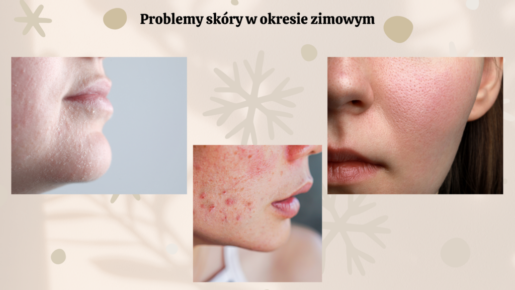 pielęgnacja skóry trądzikowej zimą pielęgnacja, zaburzona bariera, sucha skóra