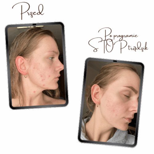 Program Stop trądzik, pielęgnacja cery trądzikowej, pryszcze, konsultacja kosmetologiczna, kosmetolog, kosmetolog online, kosmetolog Wrocław, blizny, przebarwienia, plan pielęgnacji, holistyczne podejście do trądziku,