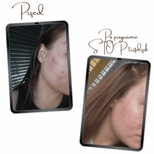 Program Stop trądzik, pielęgnacja cery trądzikowej, pryszcze, konsultacja kosmetologiczna, kosmetolog, kosmetolog online, kosmetolog Wrocław, blizny, przebarwienia, plan pielęgnacji, holistyczne podejście do trądziku,