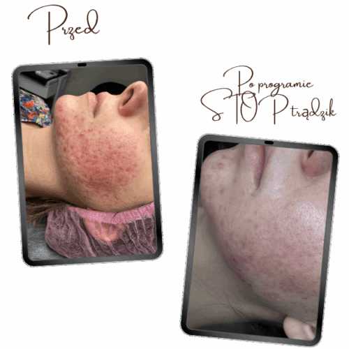 Program Stop trądzik, pielęgnacja cery trądzikowej, pryszcze, konsultacja kosmetologiczna, kosmetolog, kosmetolog online, kosmetolog Wrocław, blizny, przebarwienia, plan pielęgnacji, holistyczne podejście do trądziku,