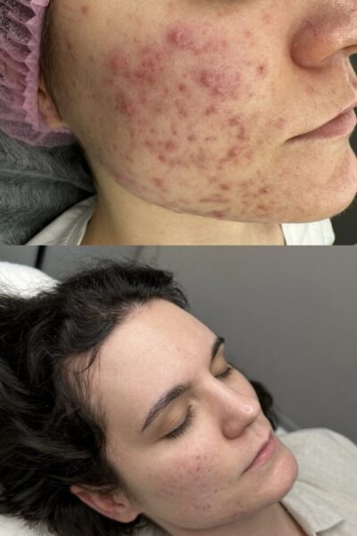 Program Stop trądzik, pielęgnacja cery trądzikowej, pryszcze, konsultacja kosmetologiczna, kosmetolog, kosmetolog online, kosmetolog Wrocław, blizny, przebarwienia, plan pielęgnacji, holistyczne podejście do trądziku,