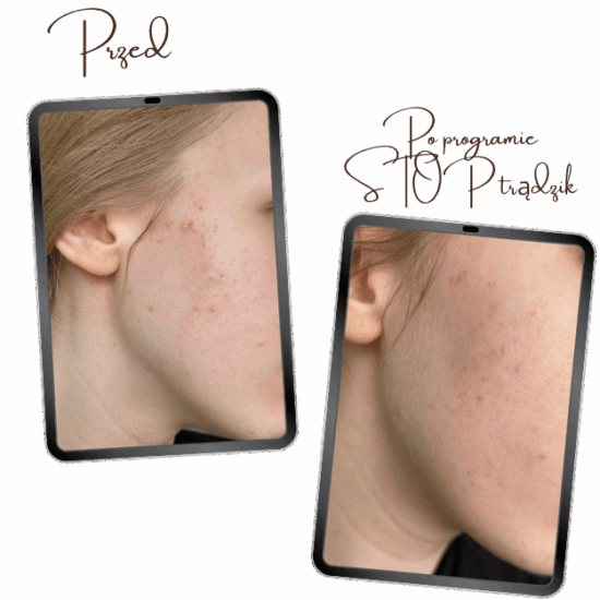 STOP Trądzik - 6‑miesięczny program do gładkiej skóry PRZED i PO